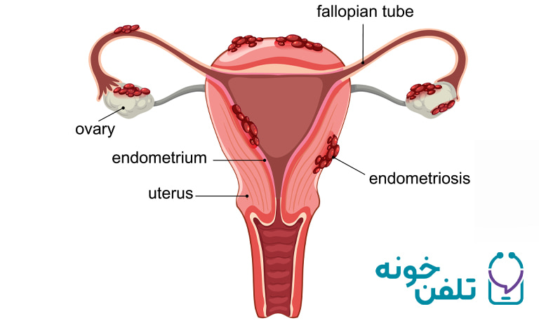 درمان اندومتریوز