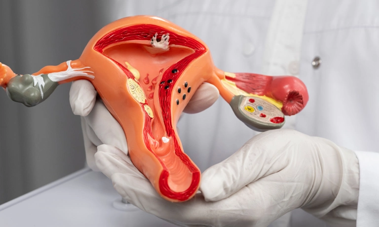 کیست تخمدان در دختران مجرد