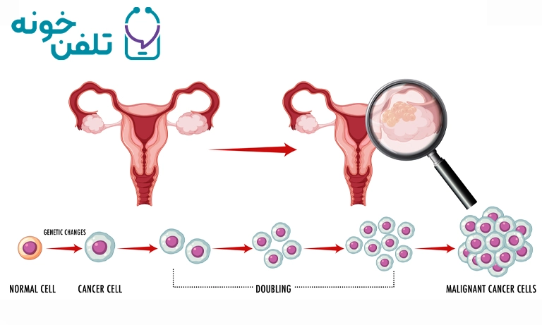 مشاوره با متخصص علائم سرطان تخمدان