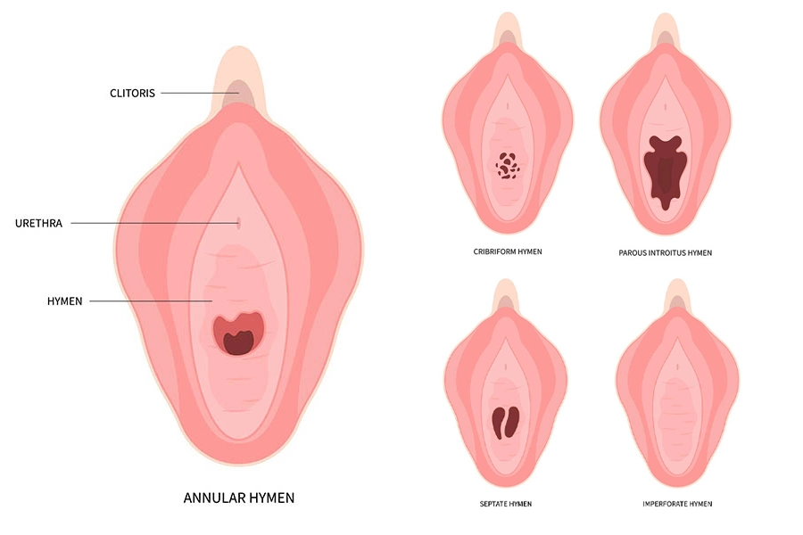 آیا پرده بکارت من سالم است؟