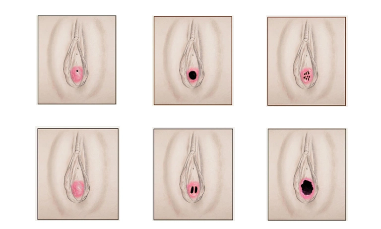 انواع مدل های پرده بکارت