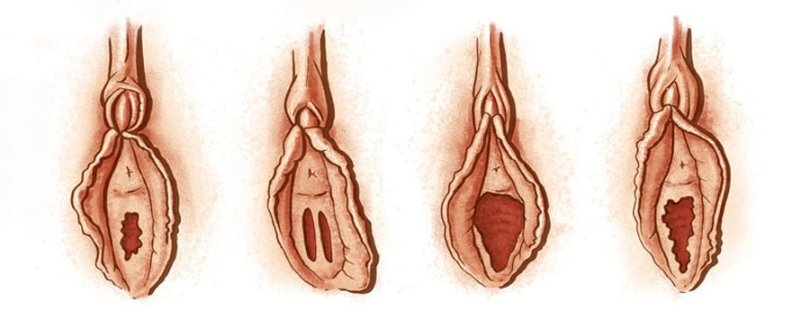 انواع پرده بکارت
