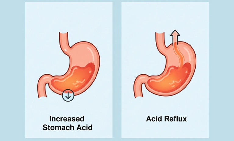 تفاوت اسید معده و رفلاکس معده