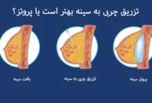 تزریق چربی به سینه بهتر است یا پروتز