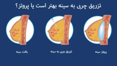 تزریق چربی به سینه بهتر است یا پروتز