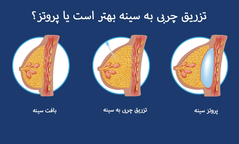 تزریق چربی به سینه بهتر است یا پروتز؟