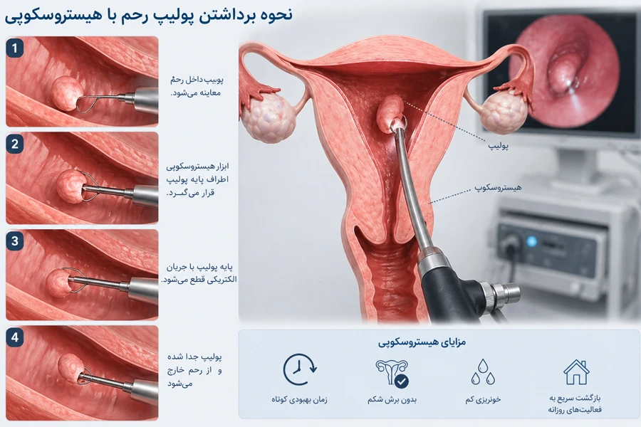 برداشتن پولیپ رحم با هیستروسکوپی