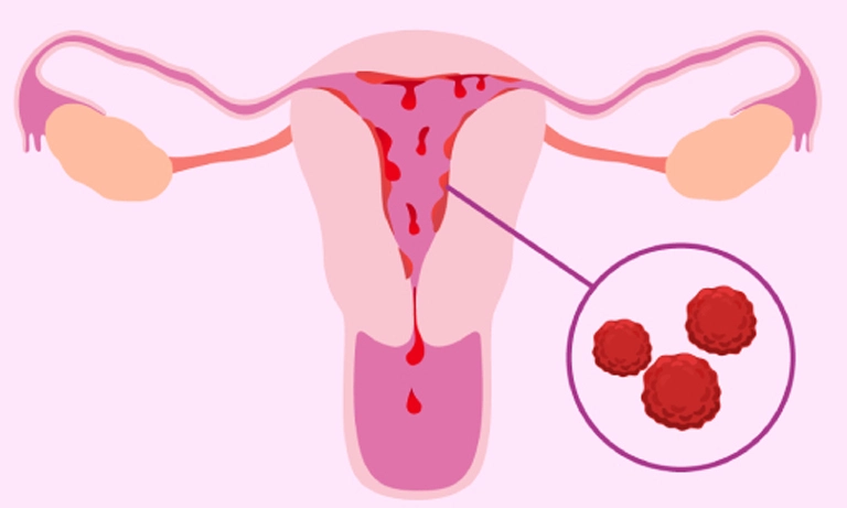 میزان خونریزی بعد از سایتوتک