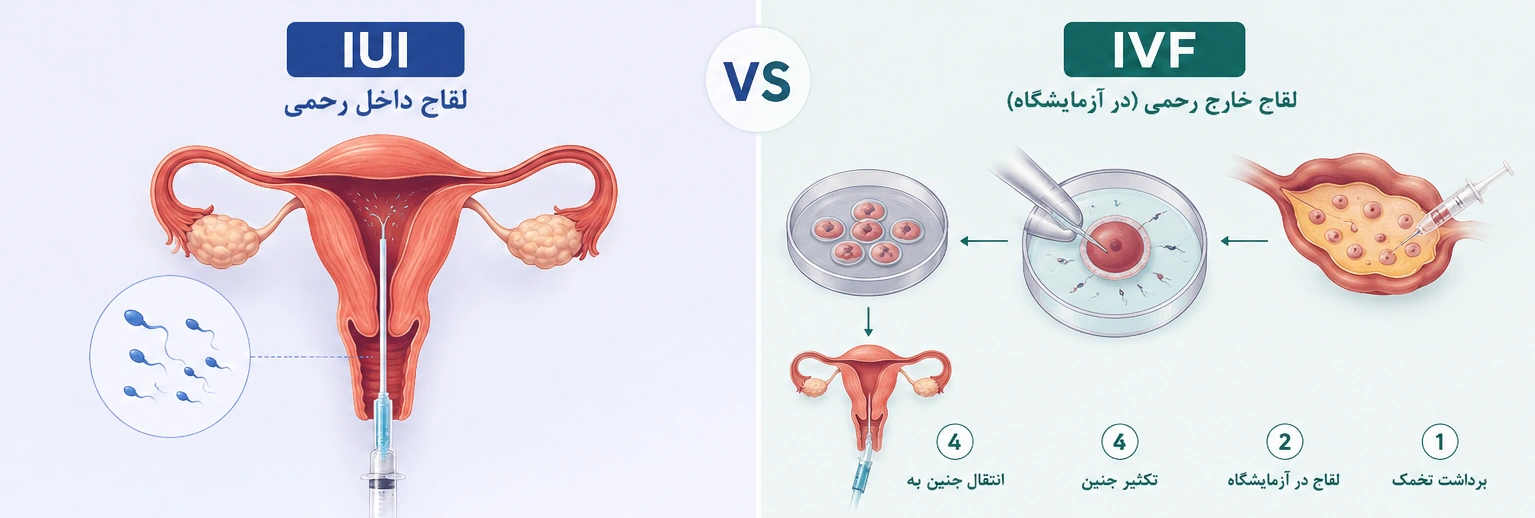 تفاوت IVF و IUI