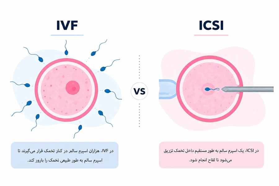 فرق IVF با IcsI