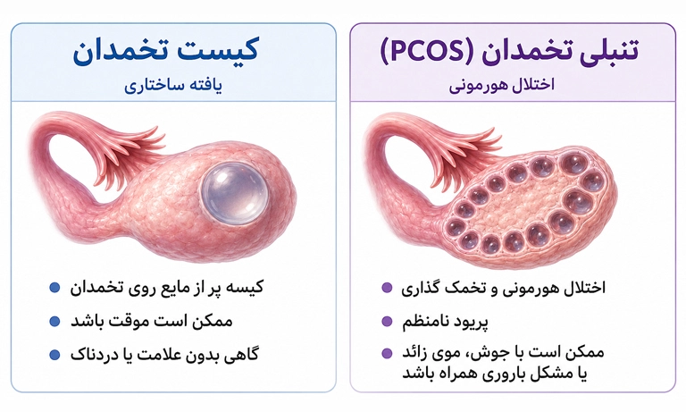 تفاوت کیست تخمدان و تنبلی تخمدان