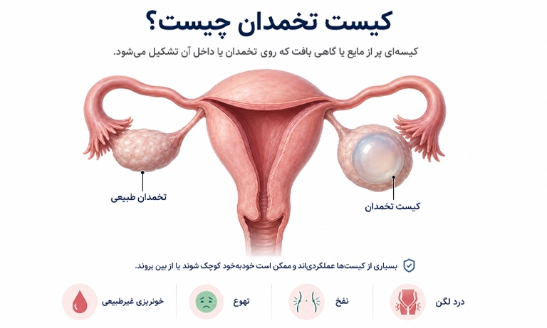 کیست تخمدان چیست