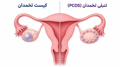 فرق بین کیست تخمدان و تنبلی تخمدان