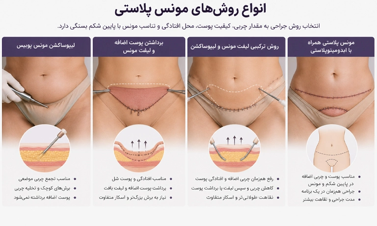انواع روش های مونس پلاستی