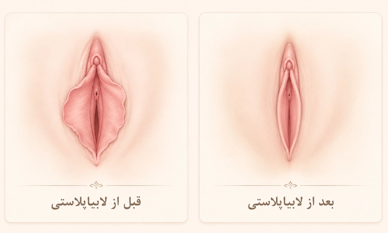تغییرات لابیاپلاستی
