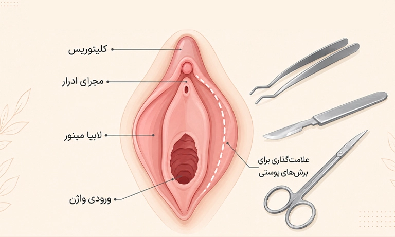 عمل زیبایی واژن