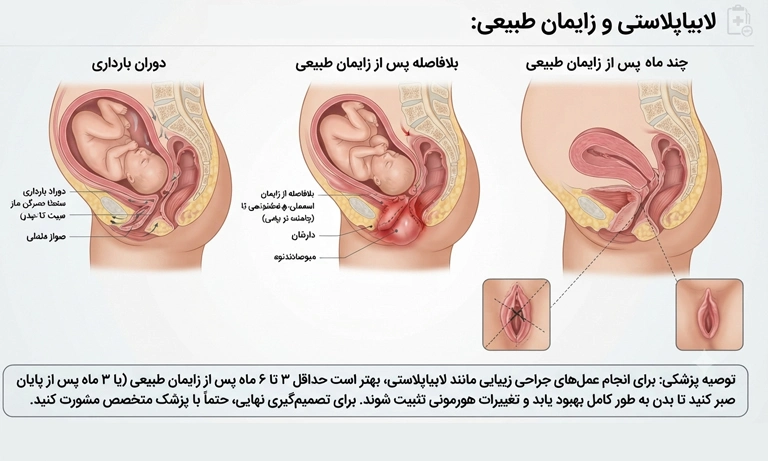 عمل لابیاپلاستی بعد از زایمان