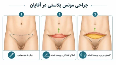 عمل مونس پلاستی آقایان