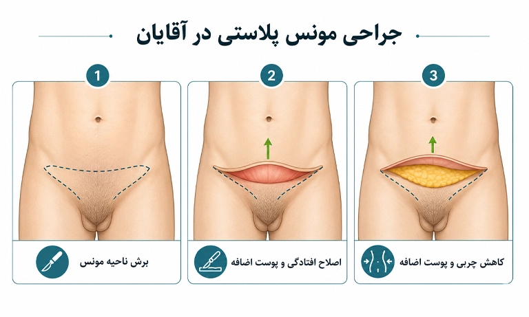عمل مونس پلاستی آقایان