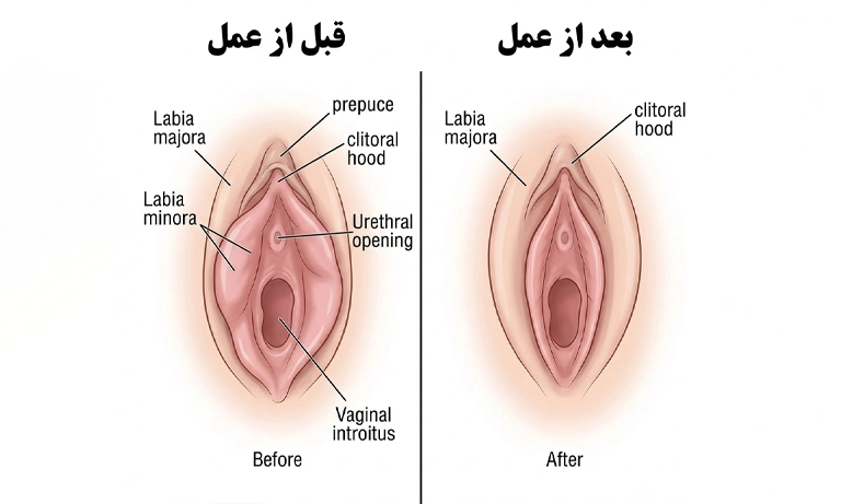 قبل و وبعد از لابیاپلاستی