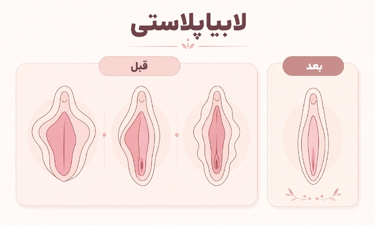 لابیاپلاستی