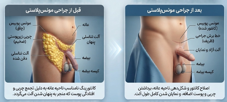 مونس پلاستی در مردان