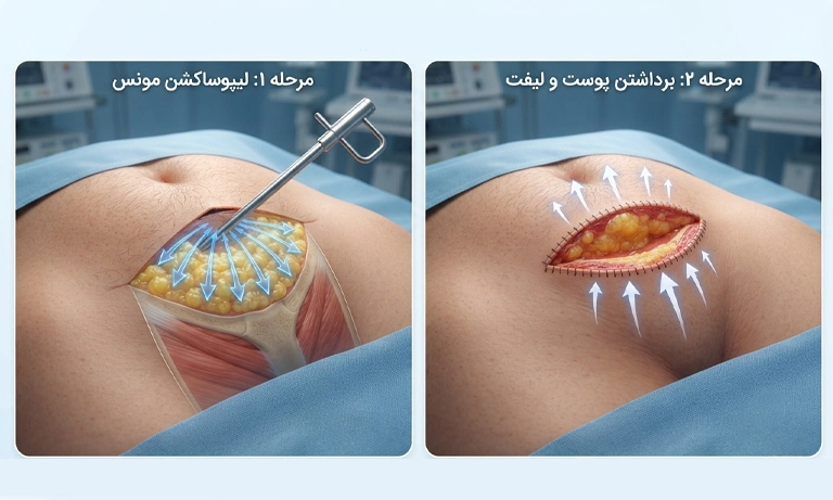 نحوه ی جراحی مونس پلاستی