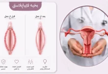 بخیه لابیا پلاستی