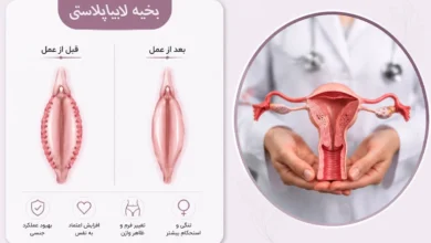 بخیه لابیا پلاستی