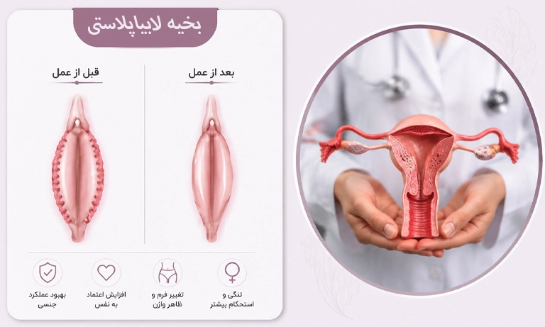 بخیه لابیا پلاستی