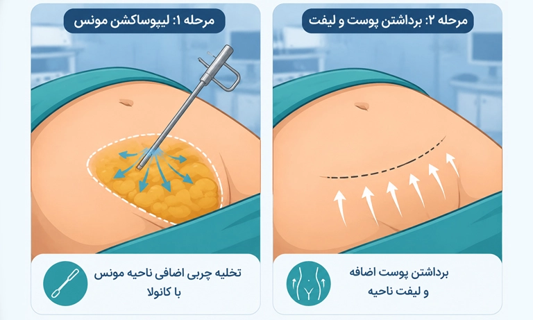 جراحی مونس 