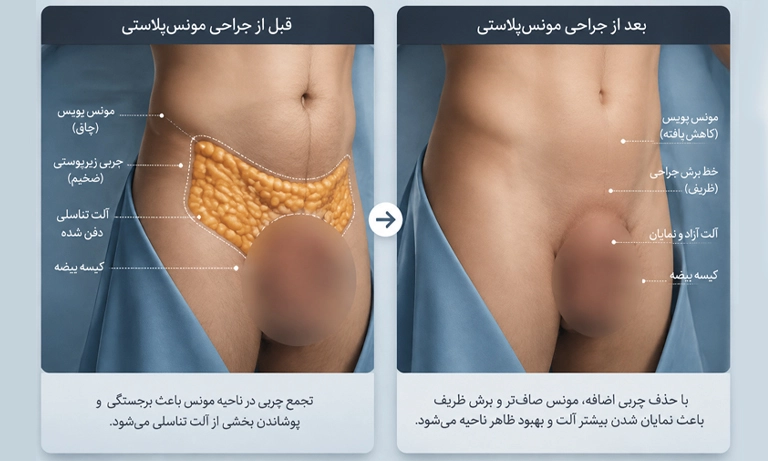 مونس پلاستی در مردان