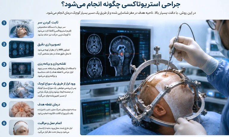 نحوه ی جراحی استروتاکسی و فانکشنال مغز و اعصاب