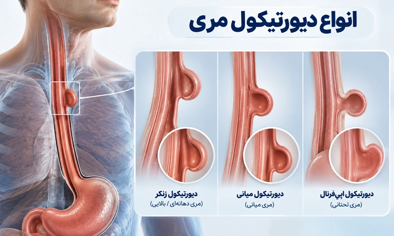 انواع دیورتیکول زنکر مری