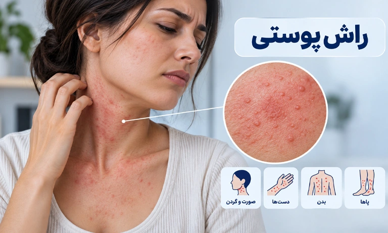 راش پوستی | علت ایجاد و نحوه درمان راش و بثورات پوستی