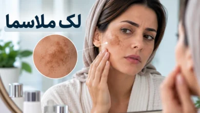 لک ملاسما
