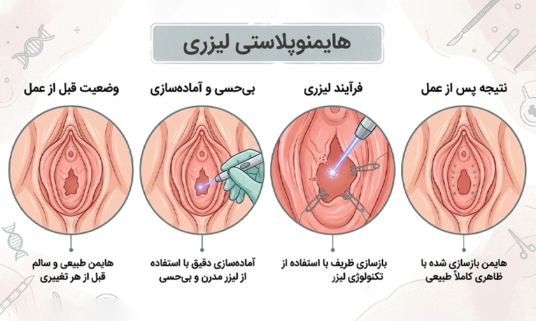 عمل هایمنوپلاستی با لیزر